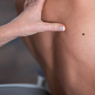 Common Signs of Melanoma That Should Never be Ignored