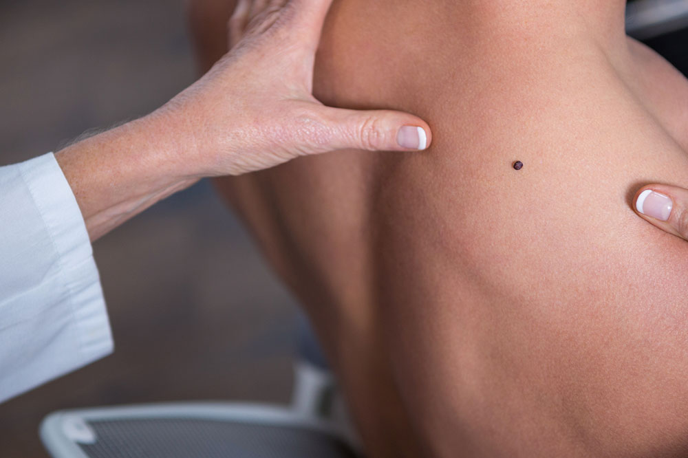 Common Signs of Melanoma That Should Never be Ignored