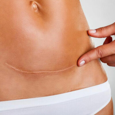 Symptoms and Preventive Tips for Ovarian Cancer