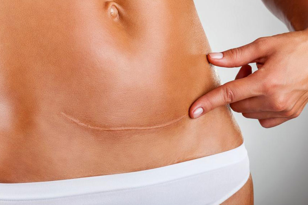 Symptoms and Preventive Tips for Ovarian Cancer