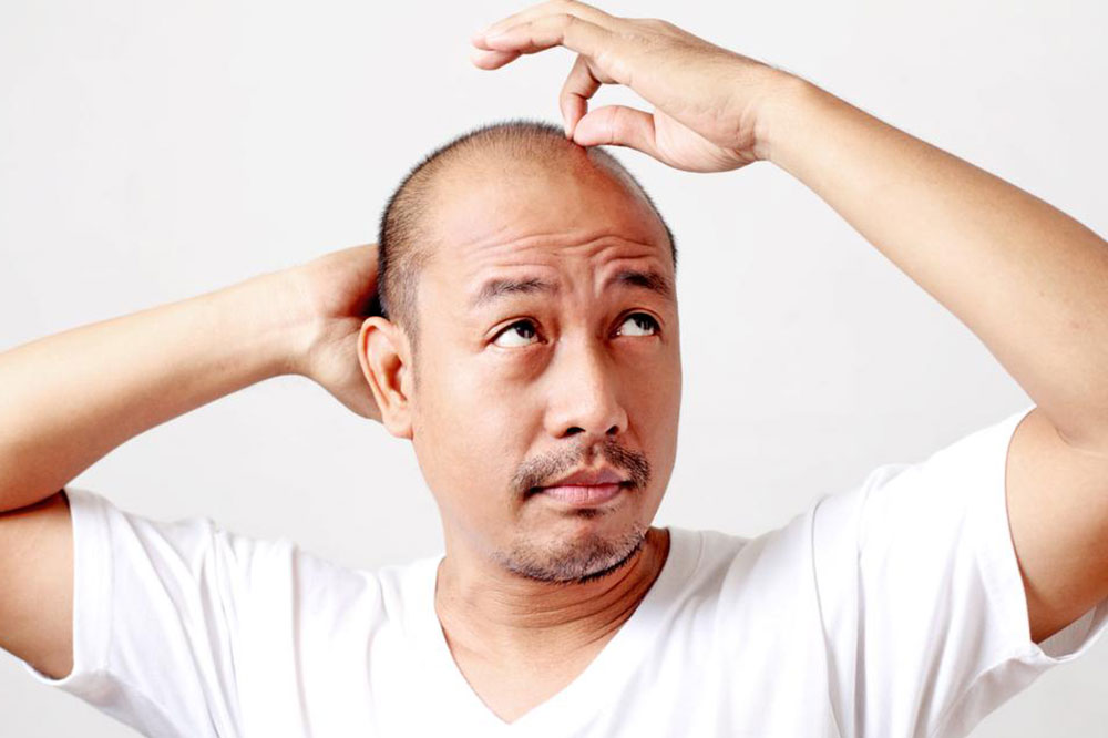 6 Natural Ways to Keep Male Pattern Baldness in Check